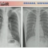 6.常见肺部感染的X线诊断——临床常见病X线读片