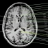 1.颅脑MRI解剖图谱-端脑MRI解剖