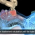 3D医学动画：气管插管技术