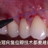 牙龈萎缩—修复牙龈微创隧道手术，看完想立马去医院搞起来