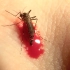 实拍一只蚊子狂吸人血到最后肚子炸掉的全过程@油兔不二字幕组
