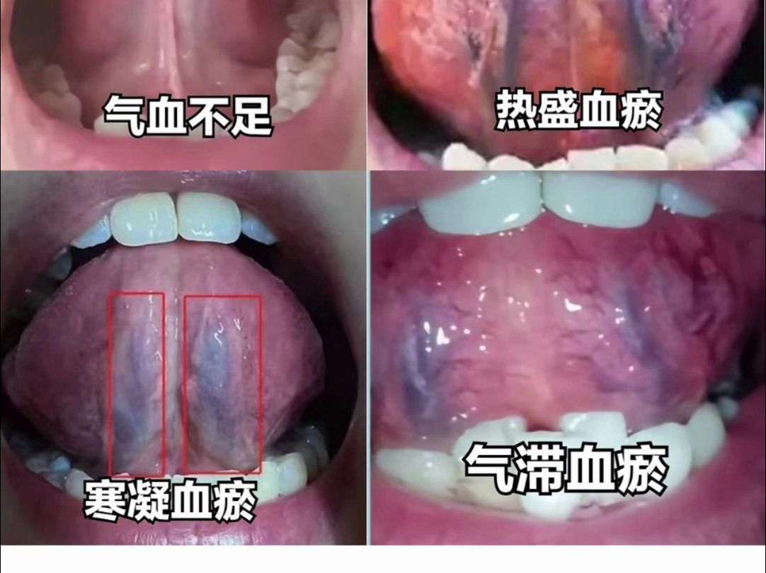四种舌下经脉体现四个疾病，来看看你中招没