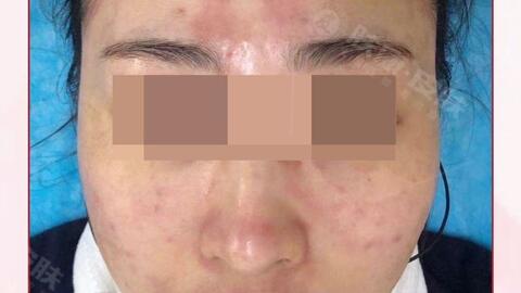 皮肤修复需要多少钱 7ed40cd3a3c3105916aec1b4ad3105878169c90f.jpg@480w_270h_1c