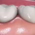 你是哪一种蛀牙？蛀牙痛怎么快速止痛？
