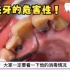 42岁日本女性第一次洗牙，口腔卫生不好，牙结石真多！