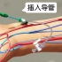 3D医学科普视频：动脉介入治疗
