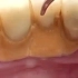 牙结石压迫牙龈
