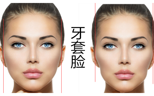 【科普】带牙套会有牙套脸?会脸颊凹陷好可啪啪啪