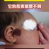 快看看有这种小黑痣吗