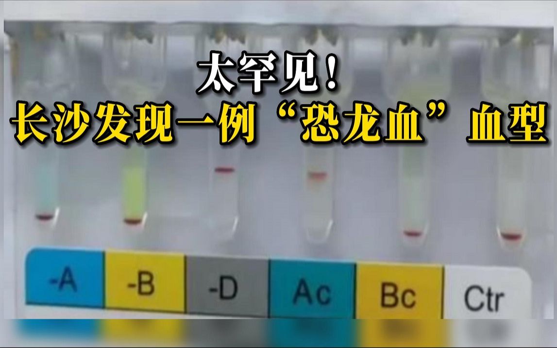 长沙发现一例“恐龙血”血型,比熊猫血更稀有哔哩哔哩bilibili