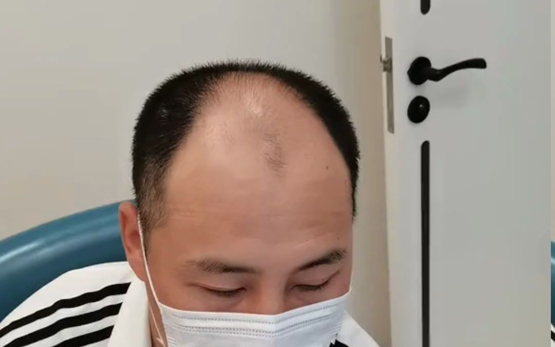 男士前额植发，术后即刻效果