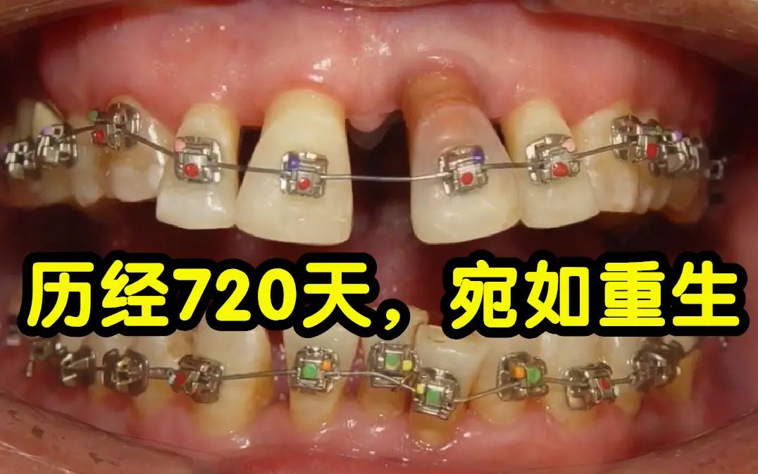 门牙重生,一场脱胎换骨的灵魂预演 门牙重生,一场脱胎换骨的灵魂预演
