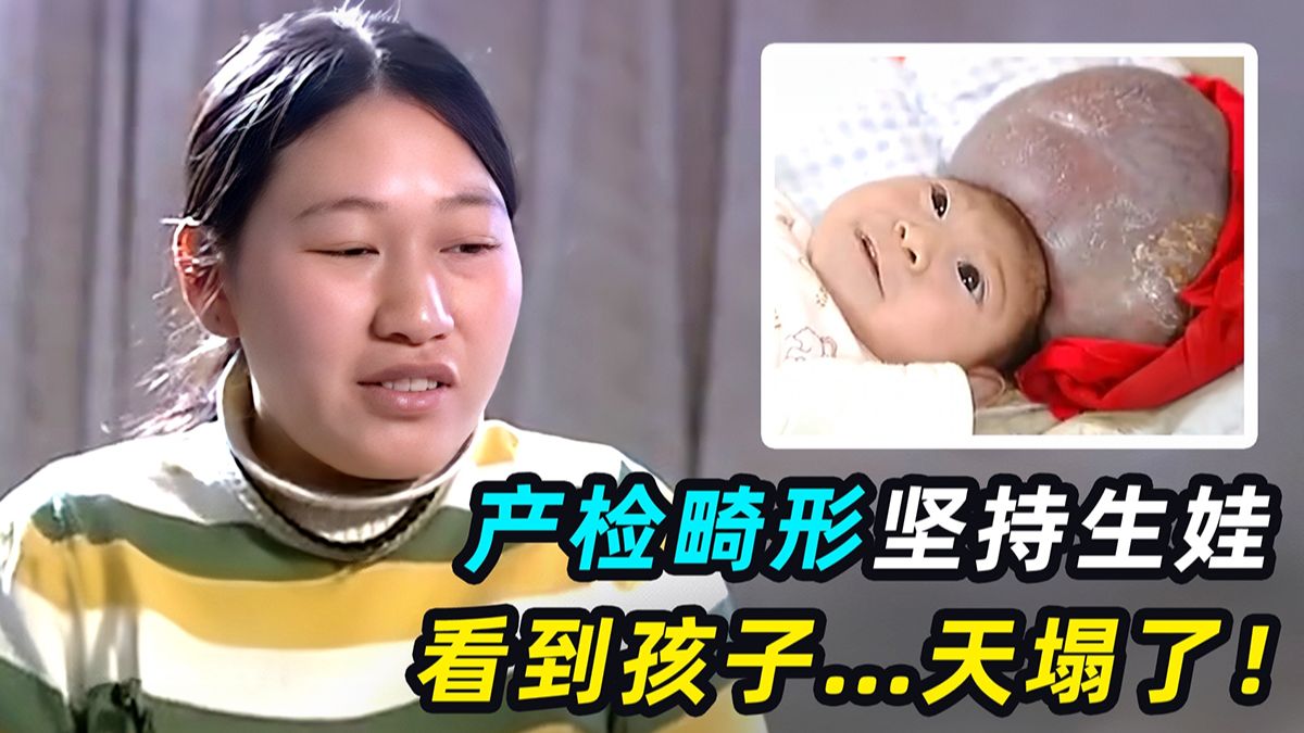 产检发现胎儿畸形，母亲坚持要生，生下来一看傻眼了