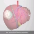 肝肿块切除手术过程，3D演示。。