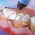 洗牙为什么那么疼？3D效果揭秘其中原理，涨知识了！
