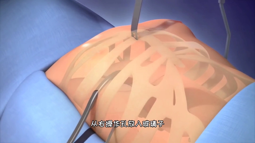 这手术也太暴力了，漏斗胸手术矫正过程，3D演示。。