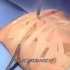 这手术也太暴力了，漏斗胸手术矫正过程，3D演示。。