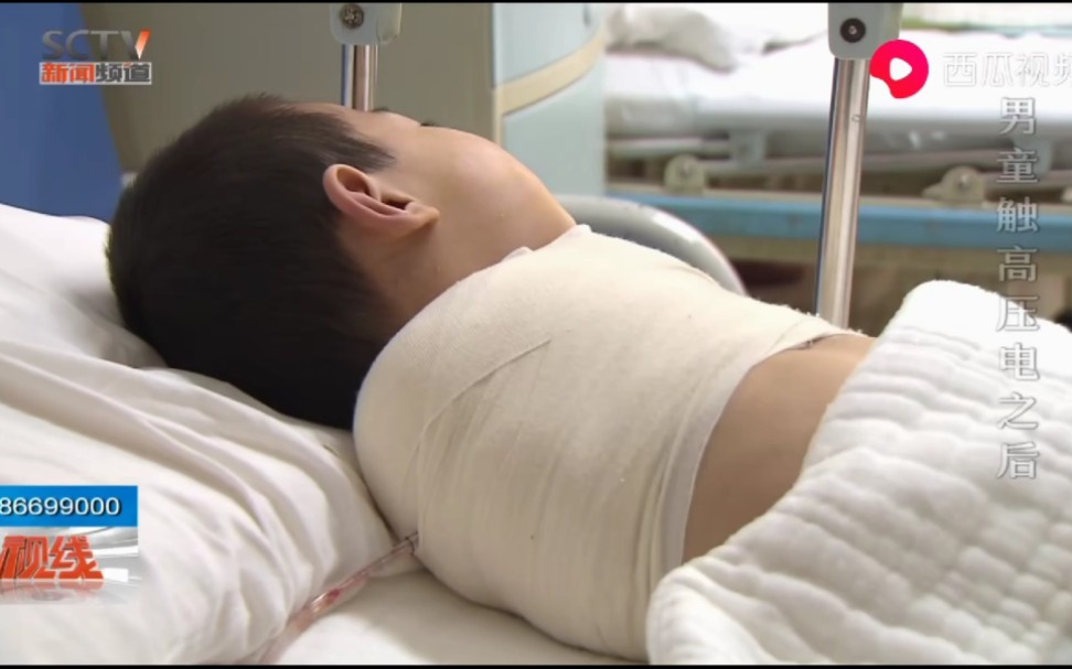 四川4岁留守男孩玩耍时遭电击伤 双臂被截肢