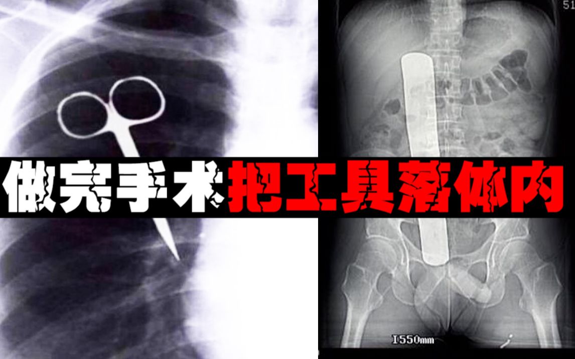 【缝合后的悲剧】手术刀忘腹腔了，患者生不如死