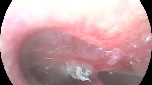 【可视采耳】自存档——用纳米棉签从下而上起半张耳皮