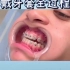 正畸科普：上牙套的全过程