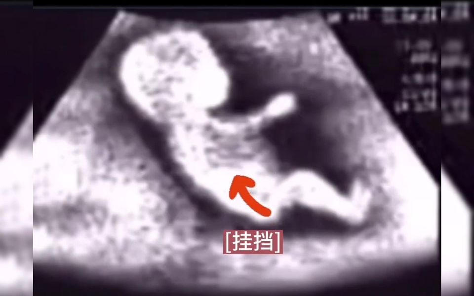 这些搞笑的胎动，可以很好看见宝宝在肚子里不安分的状态