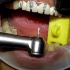 “3D/4D/5D纳米炫齿浮雕牙齿”最后的结果都是拆冠