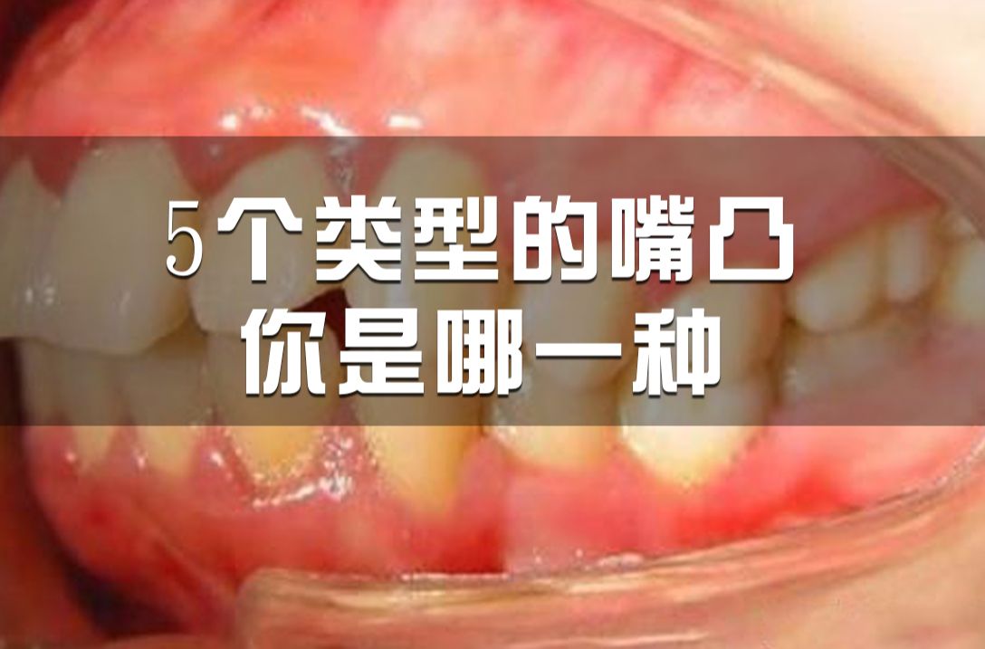 凸嘴一共有5种类型，你能分出你是哪种嘛？