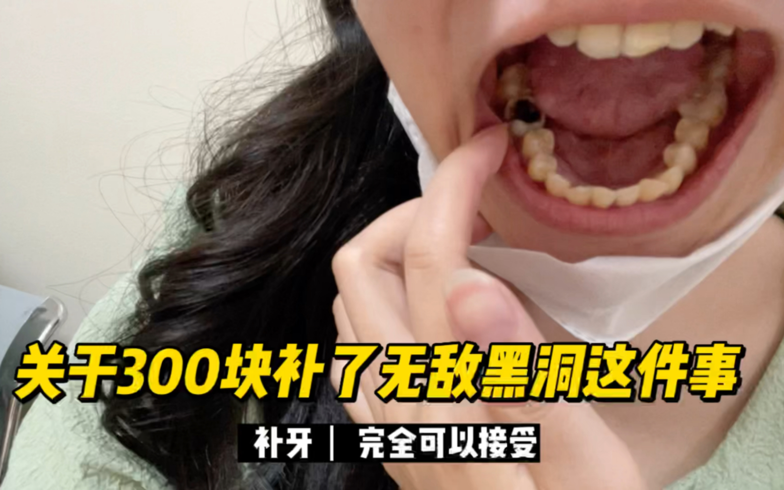 「看牙vlog 5」这么大一牙洞竟然从来没有痛过，整牙前给它补上啦