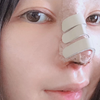 我的整形经历|鼻综合的恢复过程