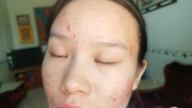 什么样的人可以吃异维a酸 91aa888f1964c0608c3c082e47a21908b77e91d6.jpg@280w_158h_1c_100q.jpg