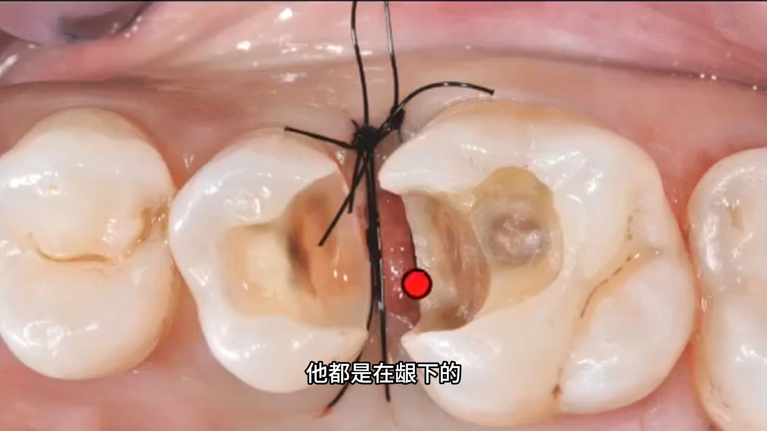 【张林】5天学会做嵌体3——龈下边缘的处理