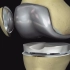 【演示】全膝关节置换手术，功能严重损坏或非常痛苦的膝盖将被人造部件替代(乐喷网/医学)(乐喷网字幕)