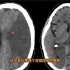 最常见脑血管疾病—脑梗塞，在CT上什么表现？放射科医生分享