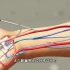 冠状动脉造影时，桡动脉穿刺怎么做，3D演示。。