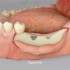 大牙缺失很久了，牙槽骨都吸收了怎么办？一起来看看！