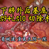 双向法 左下肺 外后基底段切除术 LS9+LS10 葛明建教授供稿