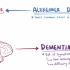 【搬运osmosis（英文+繁体）】Alzheimer's disease