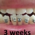 【牙齿矫正】17周的矫牙时长，下排牙齿从牙缝大到正常状态