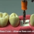 模拟种牙全过程....居然要反反复复做三次小手术