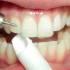 【撞撞】iTero口腔扫描仪 牙齿矫正黑科技