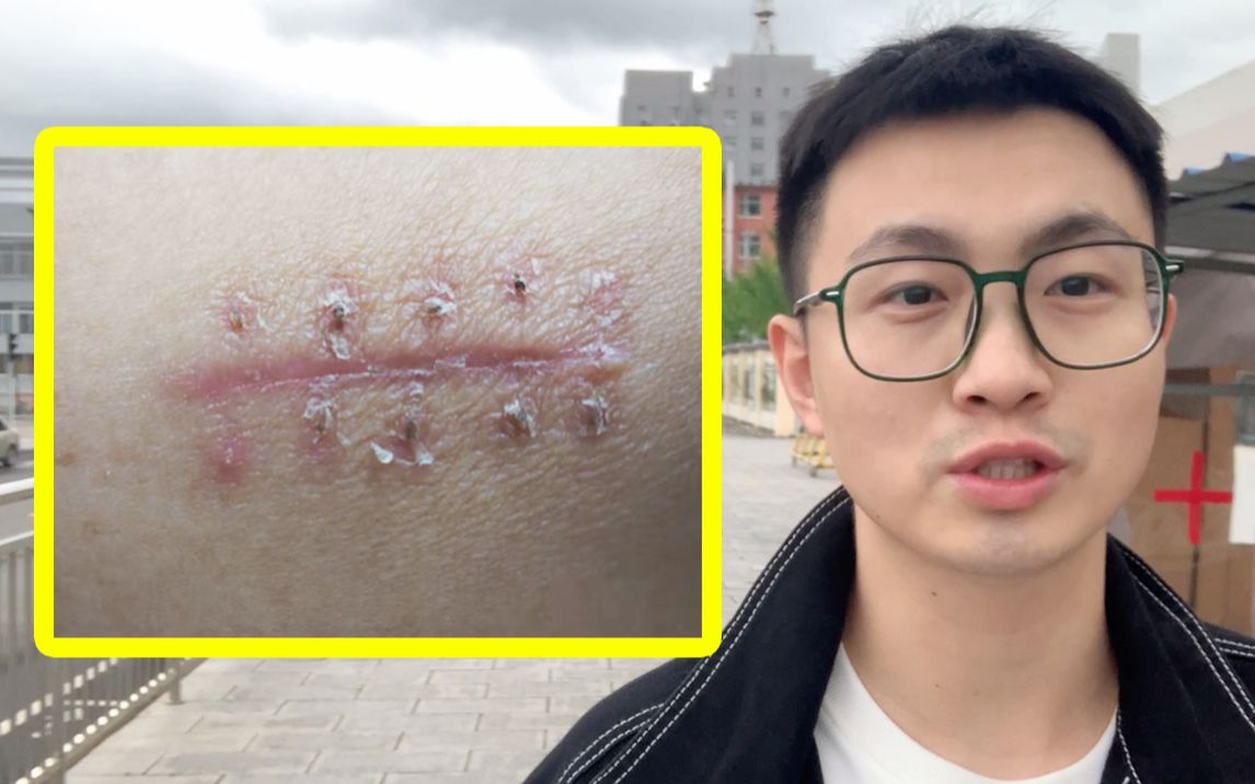 皮肤科医生手把手教你祛疤，我老姑都能学会！