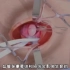 腹股沟疝手术修补手术过程，3D演示。。