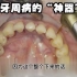 治疗牙周病的“神器”来了——激光牙周辅助治疗，能否药到病除?
