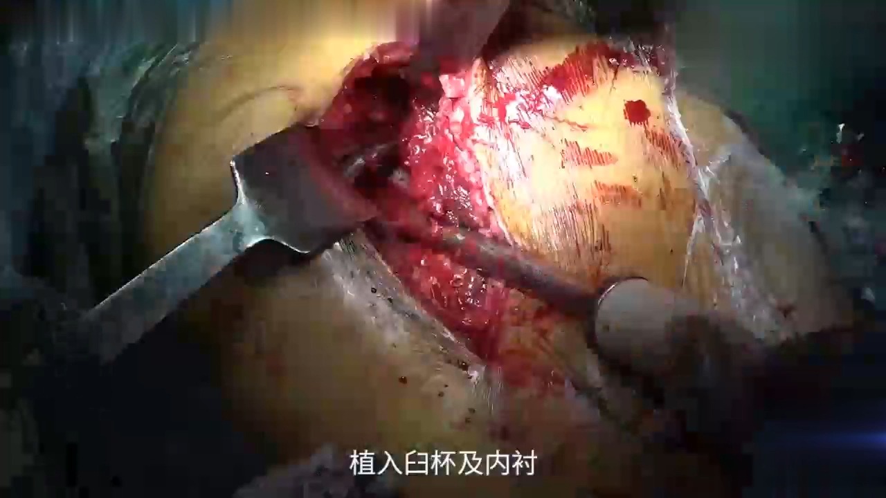 胆小慎入！全髋关节置换后外侧入路王岩教授 手术步骤教学