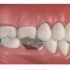 长期牙齿缺失的危害