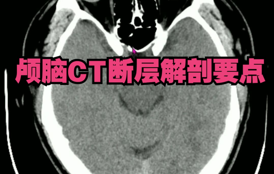 颅脑CT断层解剖基础，3分钟认识颅脑CT关键解剖位置。