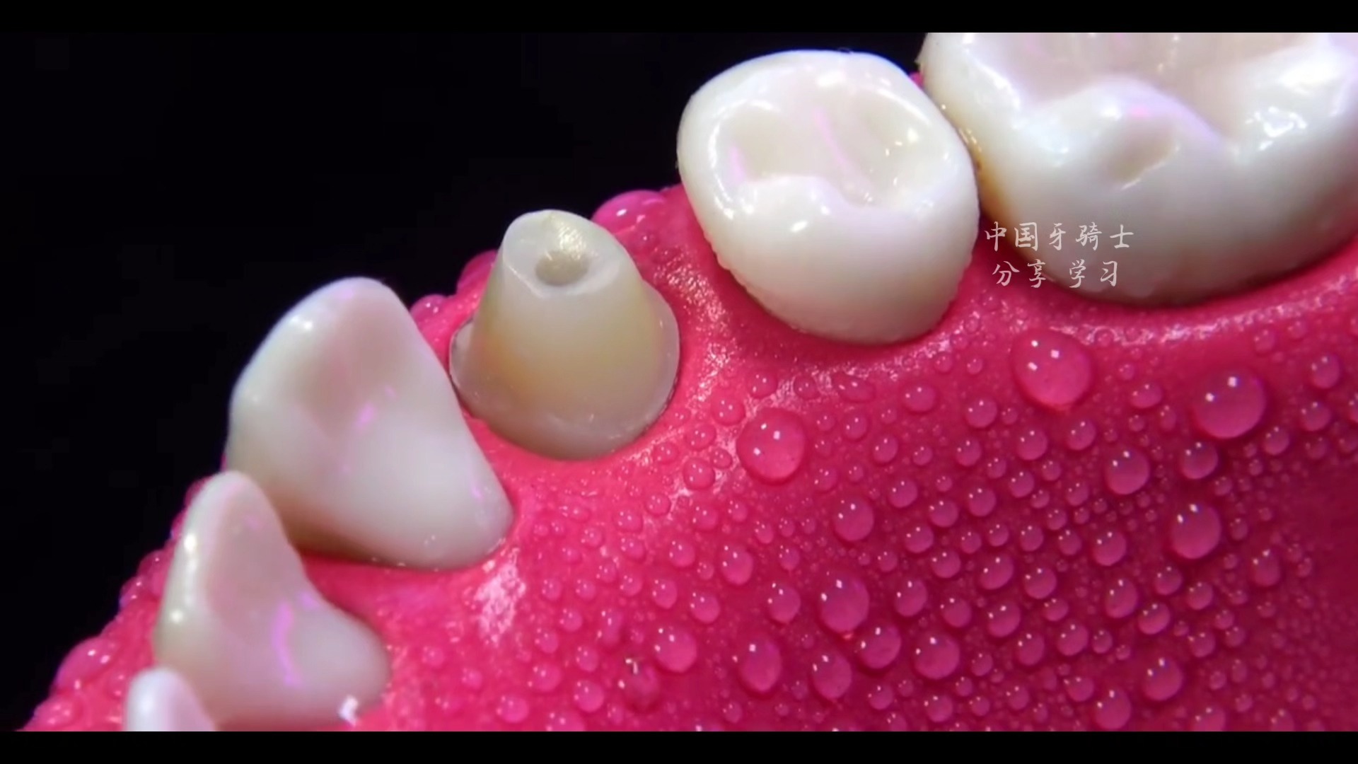 根管治疗-牙齿打桩-做冠-戴牙全过程