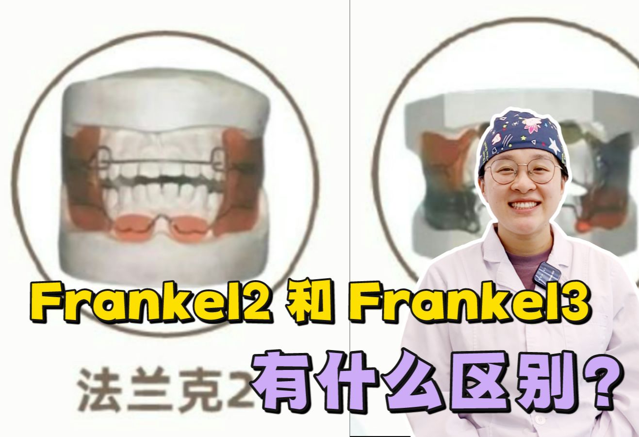 Frankel2和Frankel3有什么区别？