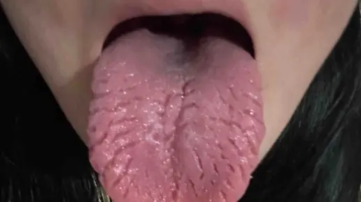 31岁小姑娘手淫十年，导致舌头严重裂纹，一点也不爱惜自己身体！